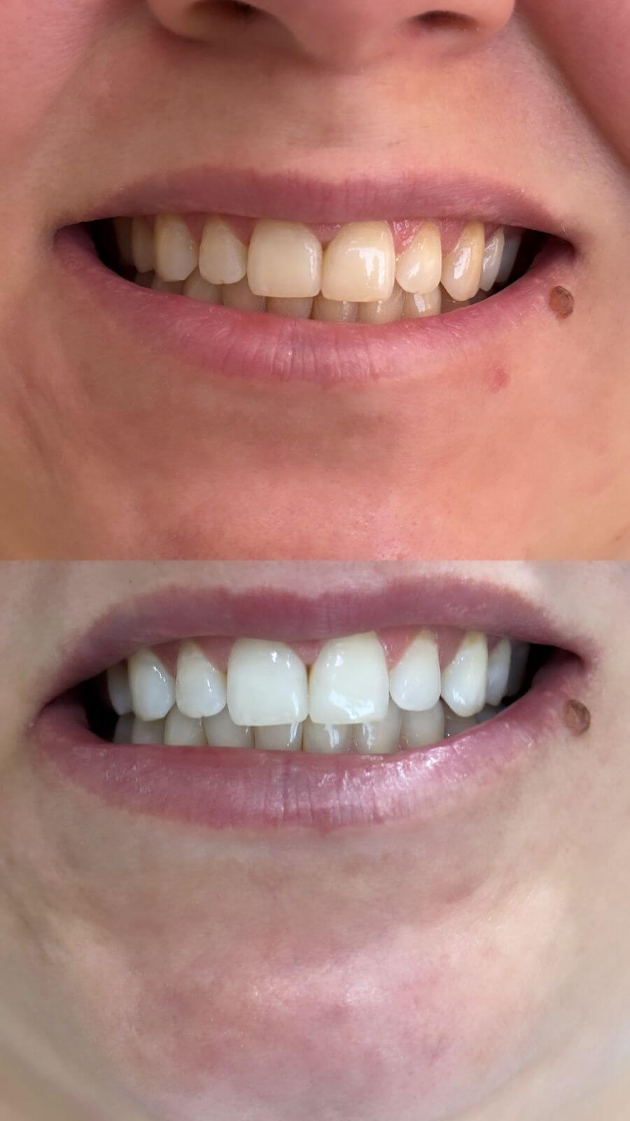 Antes e depois de facetas dentárias
